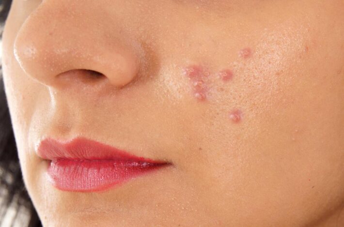 woman with hard pimples on her face
